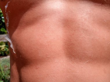 cilt üzerinde güneş yanığı etkileri. Tırmanma cilt.