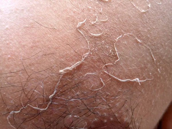 Воздействие солнечных ожогов на кожу. Восхождение на кожу . — стоковое фото