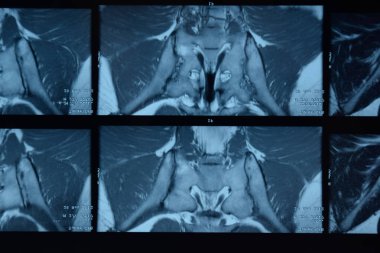 MRI sakroiliak artikülasyonu. Ankilozan spondilloartrit hastanın çalışması.