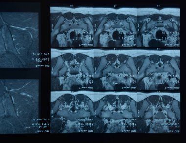MRI sakroiliak artikülasyonu. Ankilozan spondilloartrit hastanın çalışması.