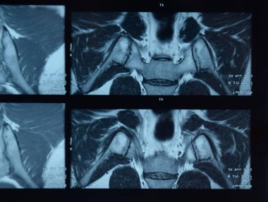 MRI sacroiliac articulation. Study of ankylosing spondyloarthritis patient. clipart