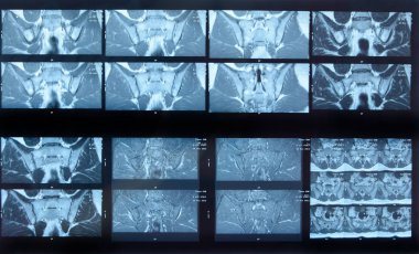MRI sakroiliak artikülasyonu. Ankilozan spondilloartrit hastanın çalışması.