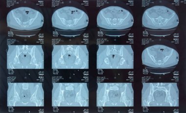 MRI sakroiliak artikülasyonu. Ankilozan spondilloartrit hastanın çalışması.