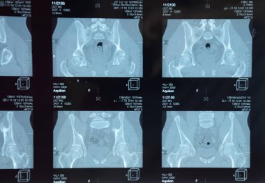 MRI sakroiliak artikülasyonu. Ankilozan spondilloartrit hastanın çalışması.