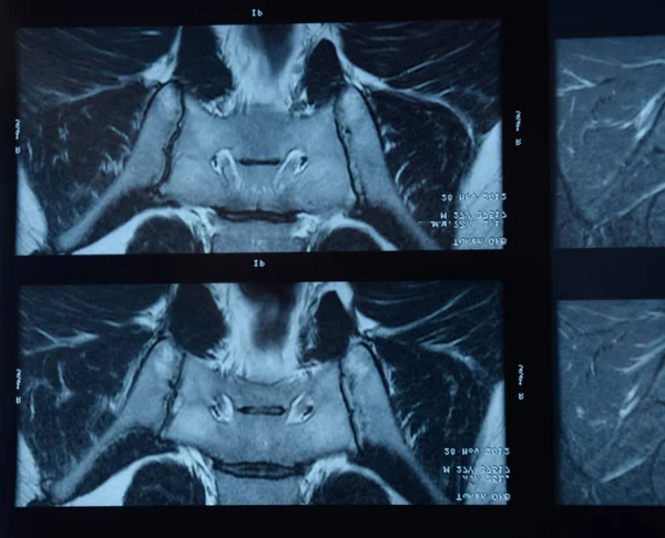 IRM articulation sacro-iliaque. Étude du patient atteint de spondyloarthrite ankylosante . — Photo