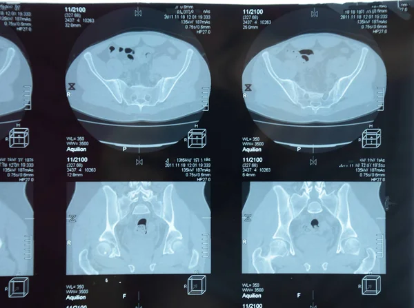 RMN articulación sacroilíaca. Estudio del paciente con espondiloartritis anquilosante . — Foto de Stock
