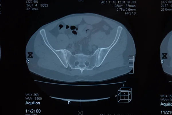 RMN articulación sacroilíaca. Estudio del paciente con espondiloartritis anquilosante . — Foto de Stock