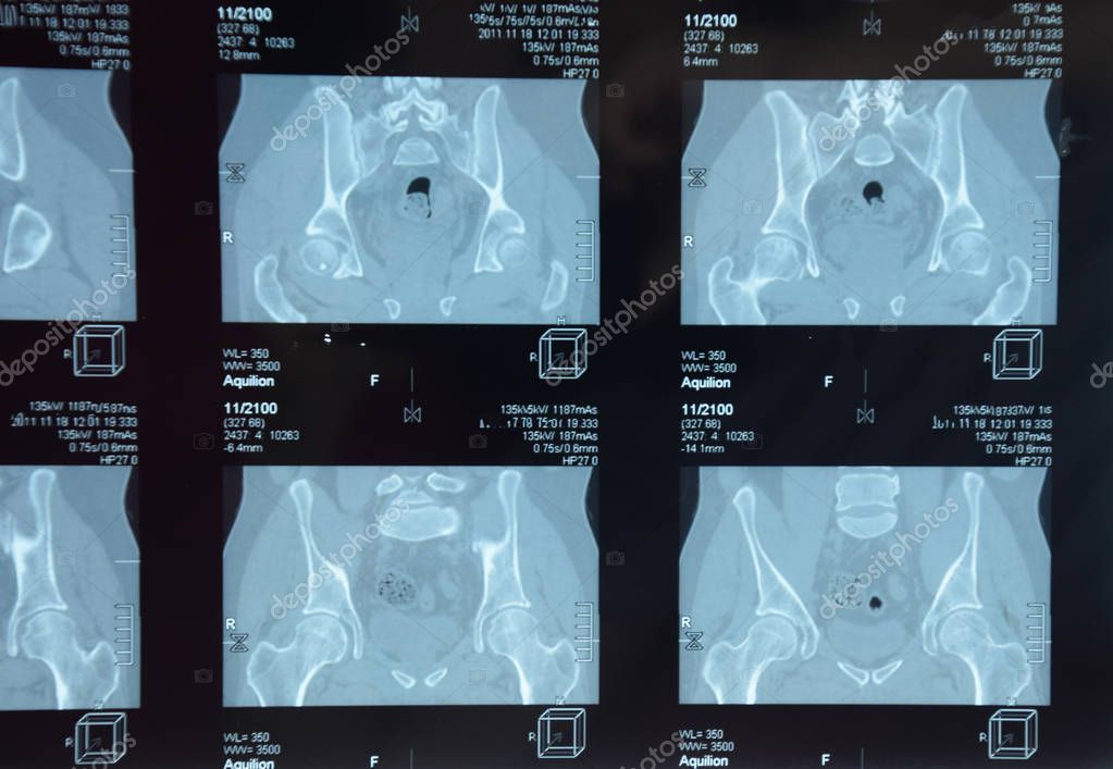 MRI sacroiliac articulation. Study of ankylosing spondyloarthritis patient. The results of the study on the x-ray.