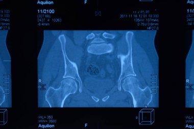 MRI sakroiliak artikülasyonu. Ankilozan spondilloartrit hastanın çalışması.