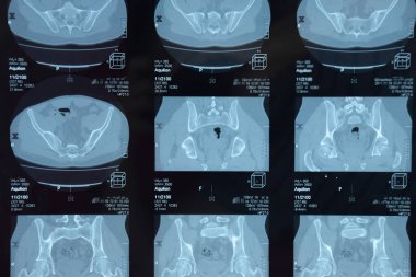 MRI sakroiliak artikülasyonu. Ankilozan spondilloartrit hastanın çalışması.