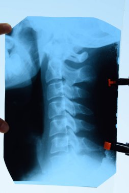 Servikal vertebranın röntgeni. Servikal omurganın X ışını görüntüsü.