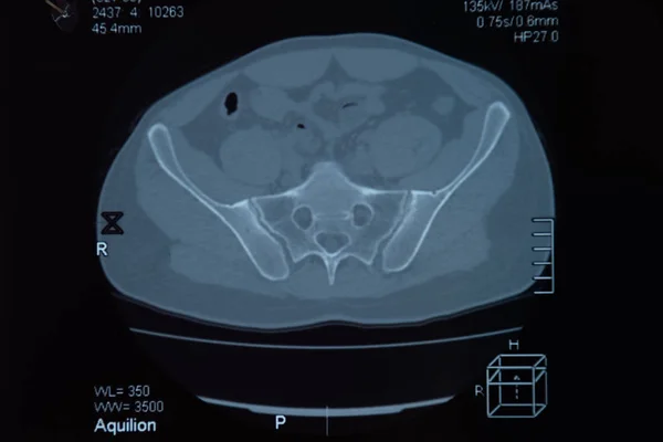 MRI sacroiliac artikuláció. Tanulmány a Bechterew-gyulladás beteg. — Stock Fotó