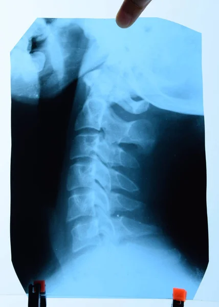 X-ray of the cervical vertebrae. X ray image of the cervical spine.