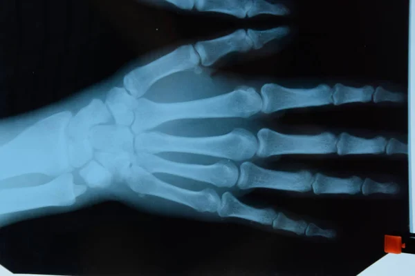 Ellerin röntgeni, x-ray'deki ellerin kemiklerinin resmi. — Stok fotoğraf