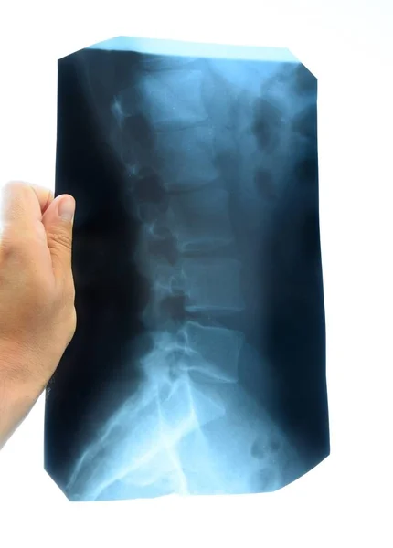 X ray of the lumbar spine, spine on x-ray — Stock Photo, Image