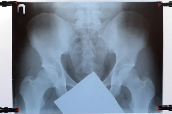 X-ray of the pelvis and sacrum. X-ray — Stock Photo, Image