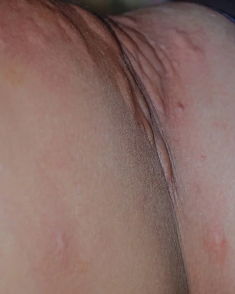 Alergia pele para trás e lados. Reações alérgicas na pele sob a forma de inchaço e vermelhidão — Fotografia de Stock