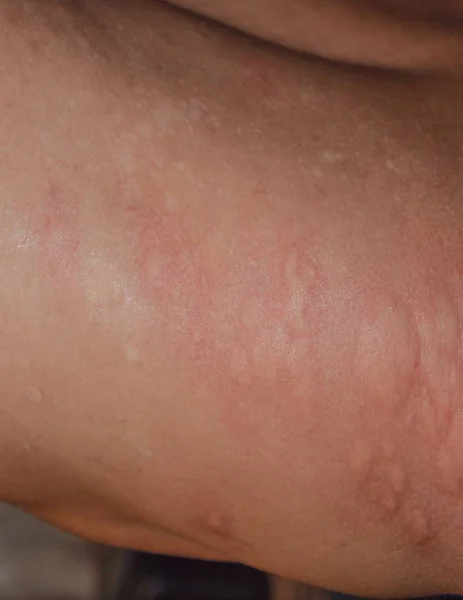 Alergi kulit kembali dan sisi. Reaksi alergi pada kulit dalam bentuk pembengkakan dan kemerahan — Stok Foto