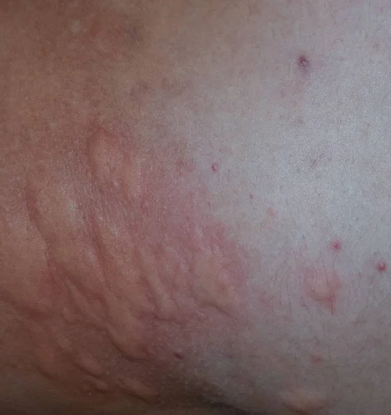 Αλλεργία δέρμα πίσω και τις πλευρές. Αλλεργικές αντιδράσεις στο δέρμα με τη μορφή οίδημα και ερυθρότητα — Φωτογραφία Αρχείου