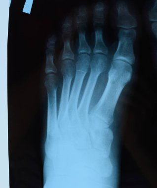 X-Ray'in de bir parçası. Xray'e ayak bas. kemik araştırmaları