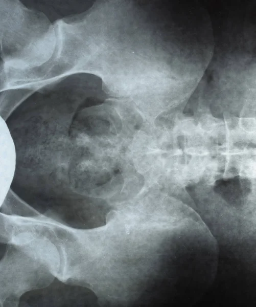 Radiographie du bassin et du sacrum. Radiographie — Photo