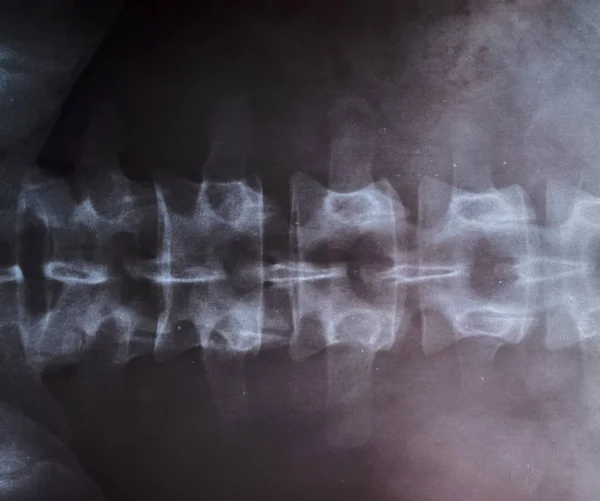X ray az ágyéki gerinc, gerinc x-ray — Stock Fotó