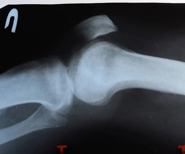 Radiografía de las articulaciones de la rodilla, una imagen de los huesos de la rodilla en la radiografía . — Foto de Stock