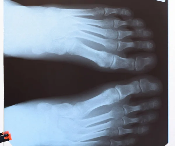 X-ray palców. Stopa na Xray. badania kości — Zdjęcie stockowe