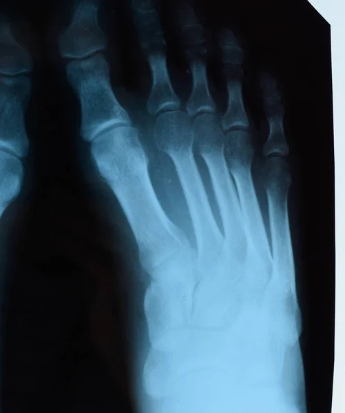 X-ray palców. Stopa na Xray. badania kości — Zdjęcie stockowe