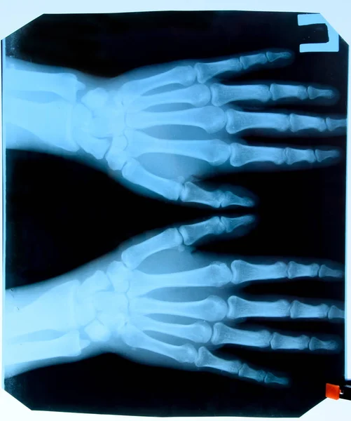 Raggio X delle mani, un'immagine delle ossa delle mani sui raggi X . — Foto Stock