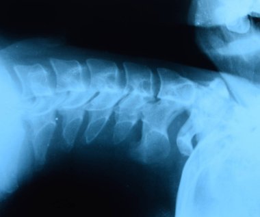 X-ray of the cervical vertebrae. X ray image of the cervical spine. clipart