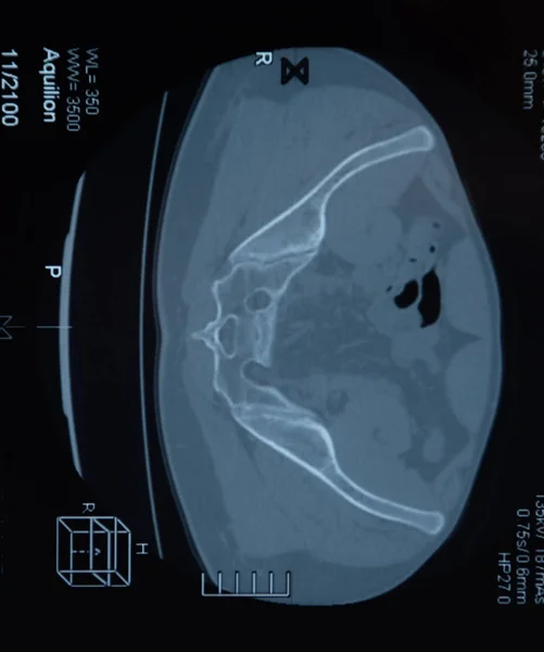 IRM articulation sacro-iliaque. Étude du patient atteint de spondyloarthrite ankylosante . — Photo