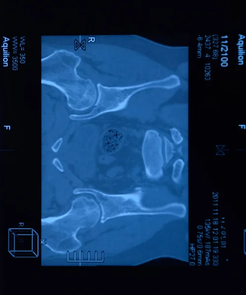 Η ιερολαγίδα της μαγνητικής τομογραφίας. Μελέτη της αγκυλωτής σπονδυλοαρθρίτιδας ασθενούς. — Φωτογραφία Αρχείου