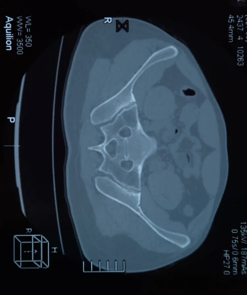 МРТ крестцово-подвздошная артикуляция. Исследование пациента с анкилозирующим спондилоартритом . — стоковое фото
