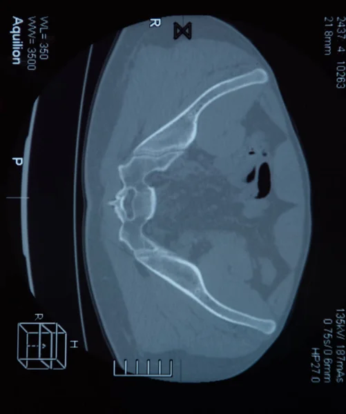МРТ крестцово-подвздошная артикуляция. Исследование пациента с анкилозирующим спондилоартритом . — стоковое фото