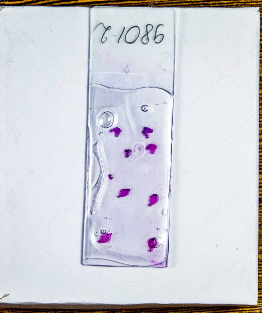 Slices of the tumor under glass. Histological examination of tumor cells for the presence of cancer