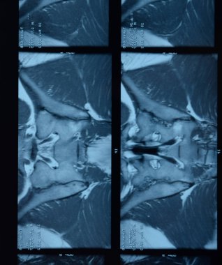 MRI sakroiliak artikülasyonu. Ankilozan spondilloartrit hastanın çalışması.