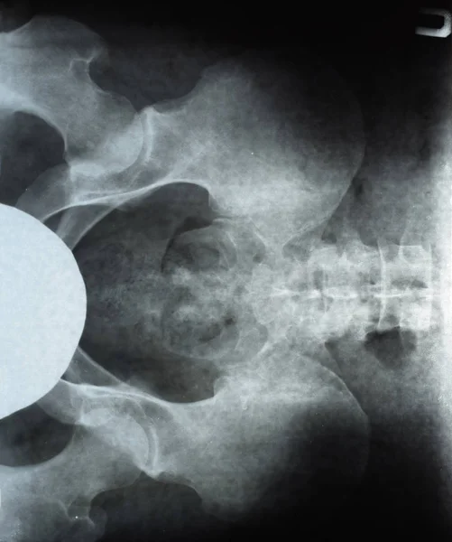 Radiographie du bassin et du sacrum. Radiographie — Photo