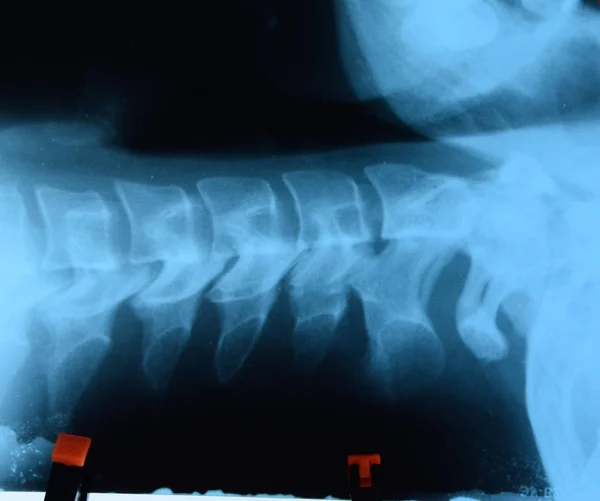 颈椎的X光片。颈椎的X射线图像. — 图库照片