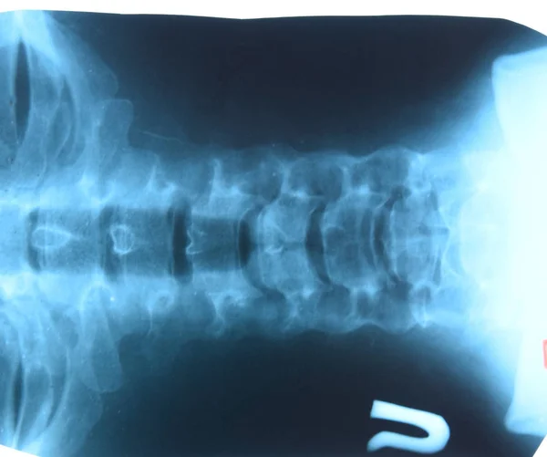 颈椎的X光片。颈椎的X射线图像. — 图库照片