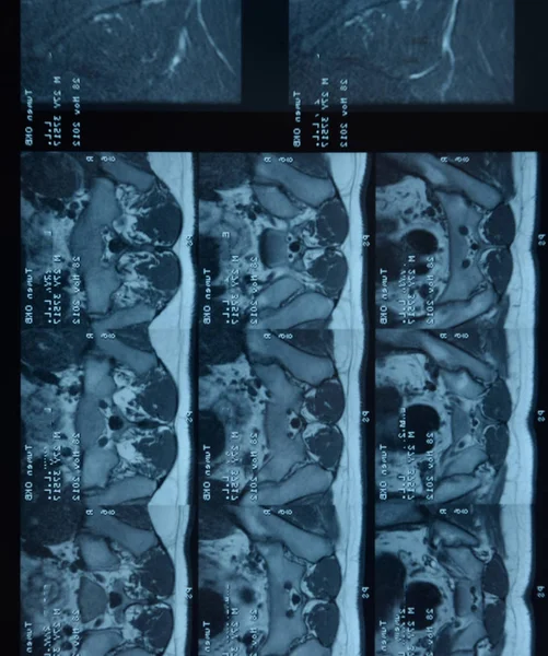 Przegubu krzyżowo-biodrowych MRI. Badanie zesztywniającego spondyloartropatii pacjenta. — Zdjęcie stockowe