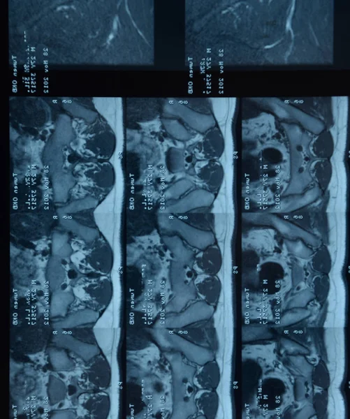 MRI sacroiliac articulation. Study of ankylosing spondyloarthritis patient. — Stock Photo, Image