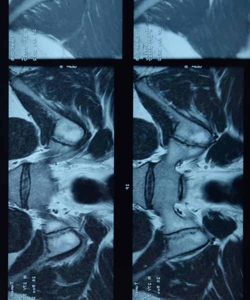 RMN articulación sacroilíaca. Estudio del paciente con espondiloartritis anquilosante . — Foto de Stock