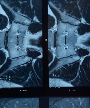 MRI sakroiliak artikülasyonu. Ankilozan spondilloartrit hastanın çalışması.