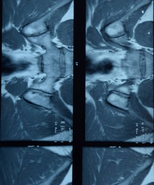 MRI sakroiliak artikülasyonu. Ankilozan spondilloartrit hastanın çalışması.