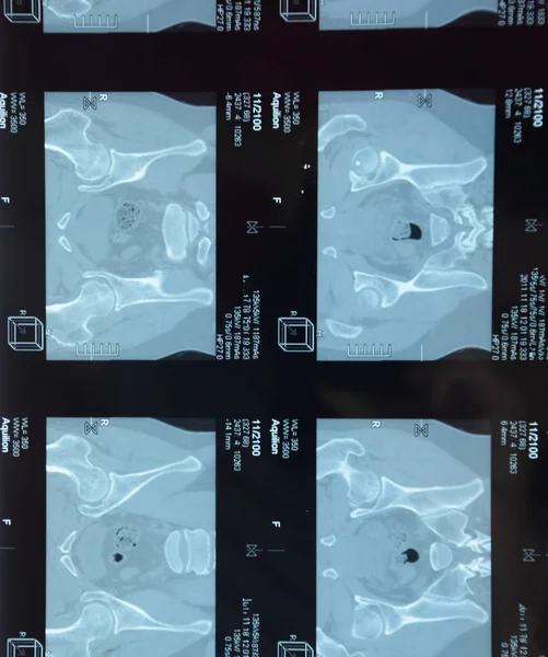 RMN articulación sacroilíaca. Estudio del paciente con espondiloartritis anquilosante . — Foto de Stock