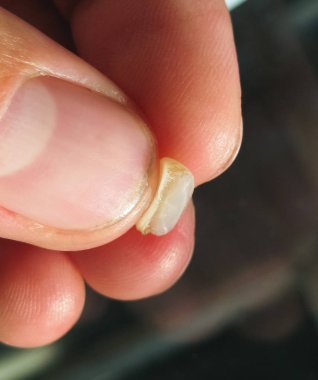 Yaşlı bir kesici ile doldurma düşmüş. Diş ve mühür.