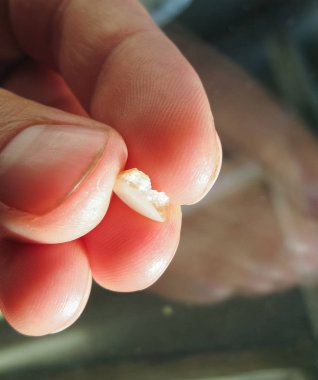 Yaşlı bir kesici ile doldurma düşmüş. Diş ve mühür.