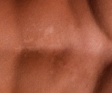 Mide cilt üzerinde güneş yanığı. Pul pul dökülme, cilt peeling. Tehlikeli güneş tan