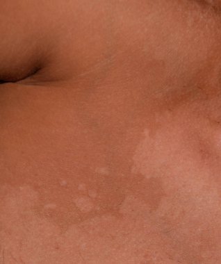 Omuz cilt üzerinde güneş yanığı. Pul pul dökülme, cilt peeling. Tehlikeli güneş tan